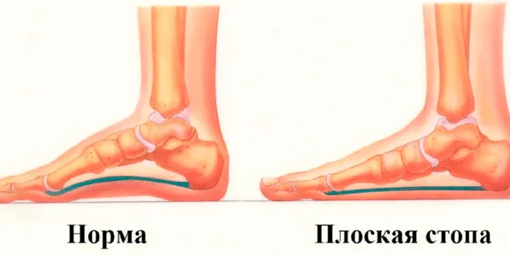 Можно ли бегать с плоскостопием?